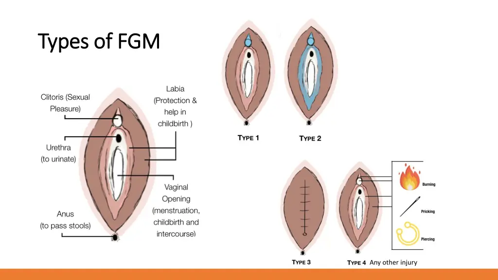 types of fgm types of fgm