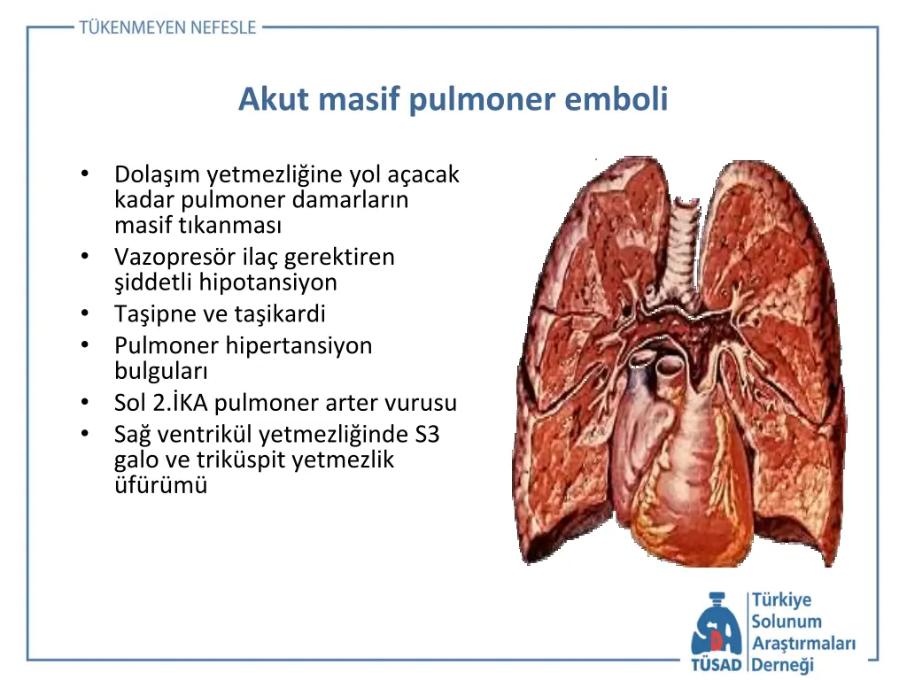 akut masif pulmoner emboli