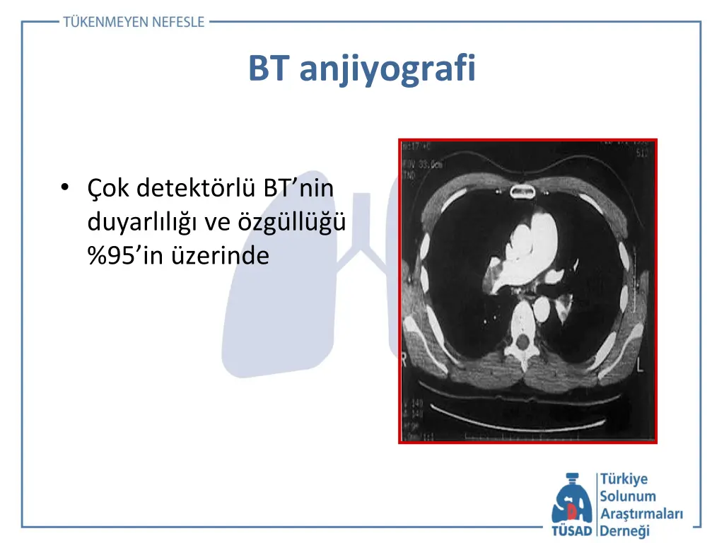 bt anjiyografi