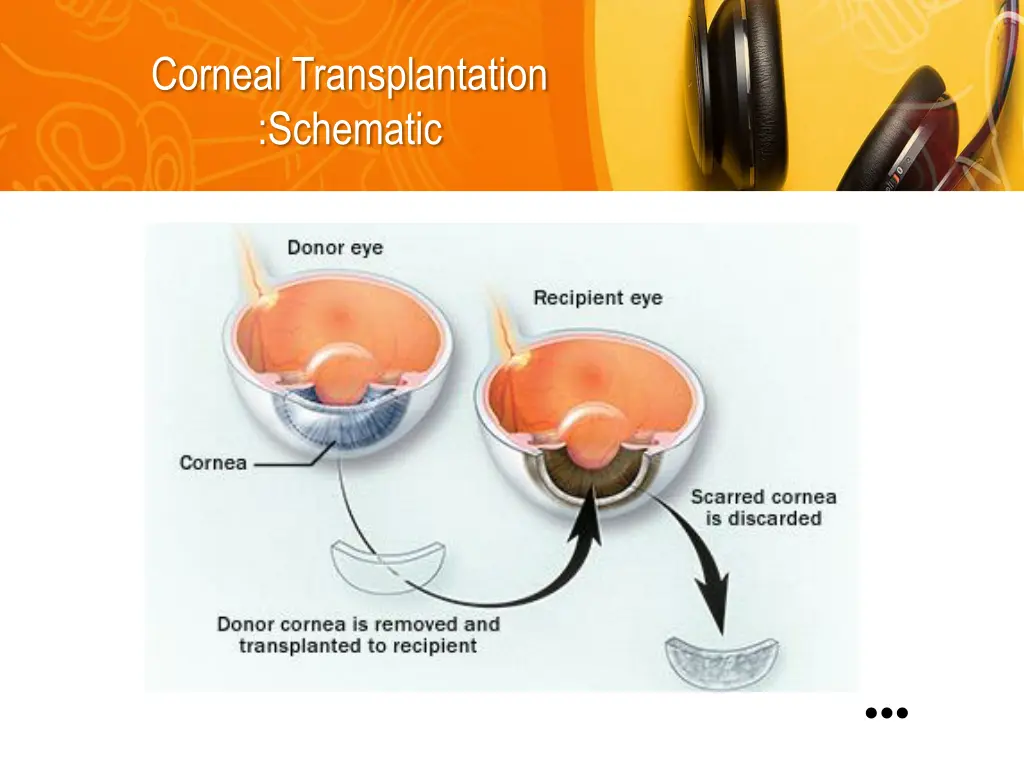 corneal transplantation schematic