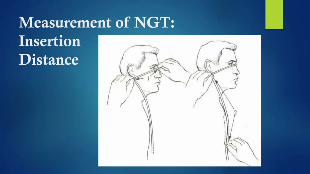 measurement of ngt insertion distance