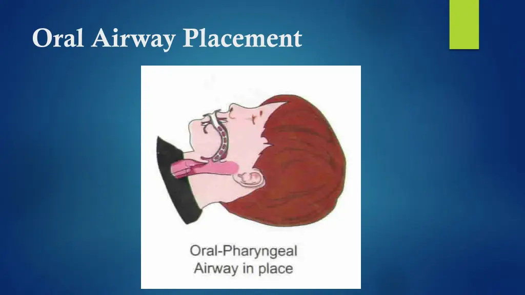 oral airway placement