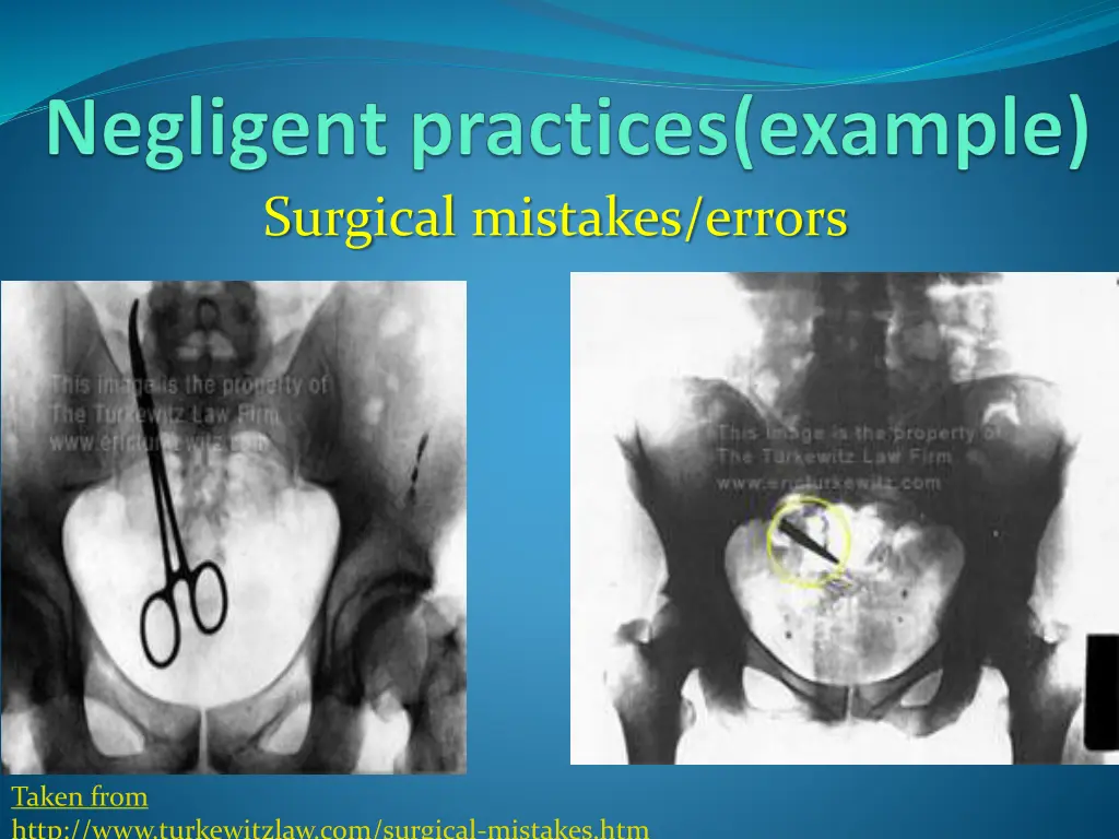 surgical mistakes errors