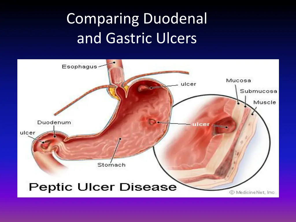 comparing duodenal and gastric ulcers