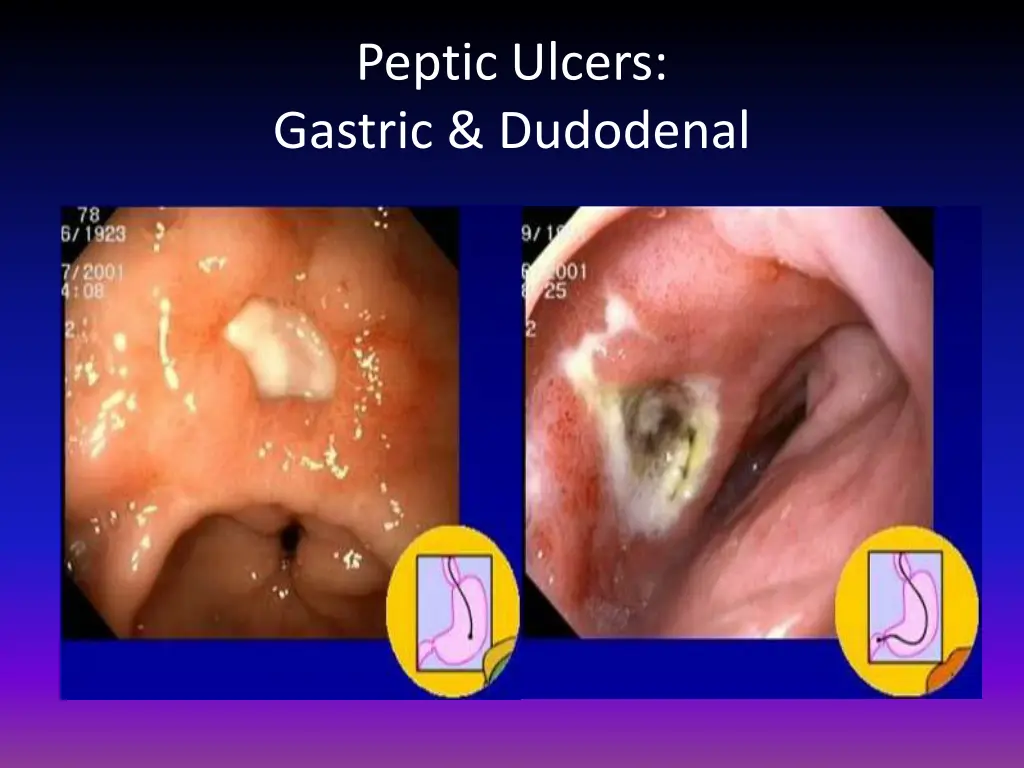 peptic ulcers gastric dudodenal
