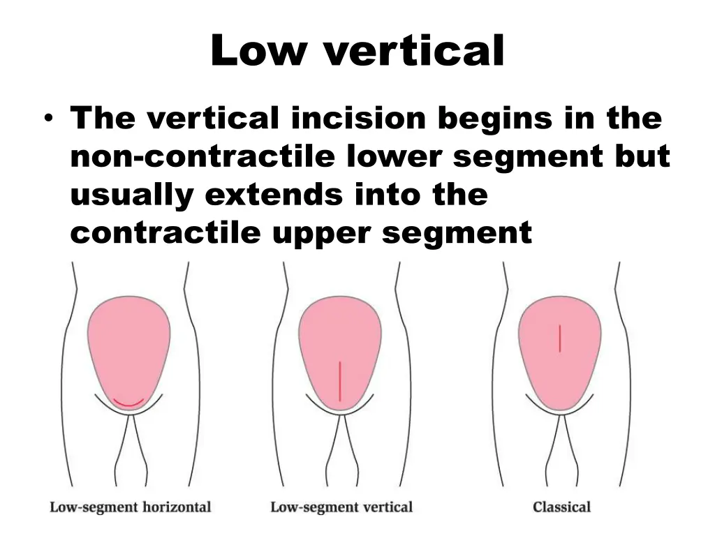 low vertical