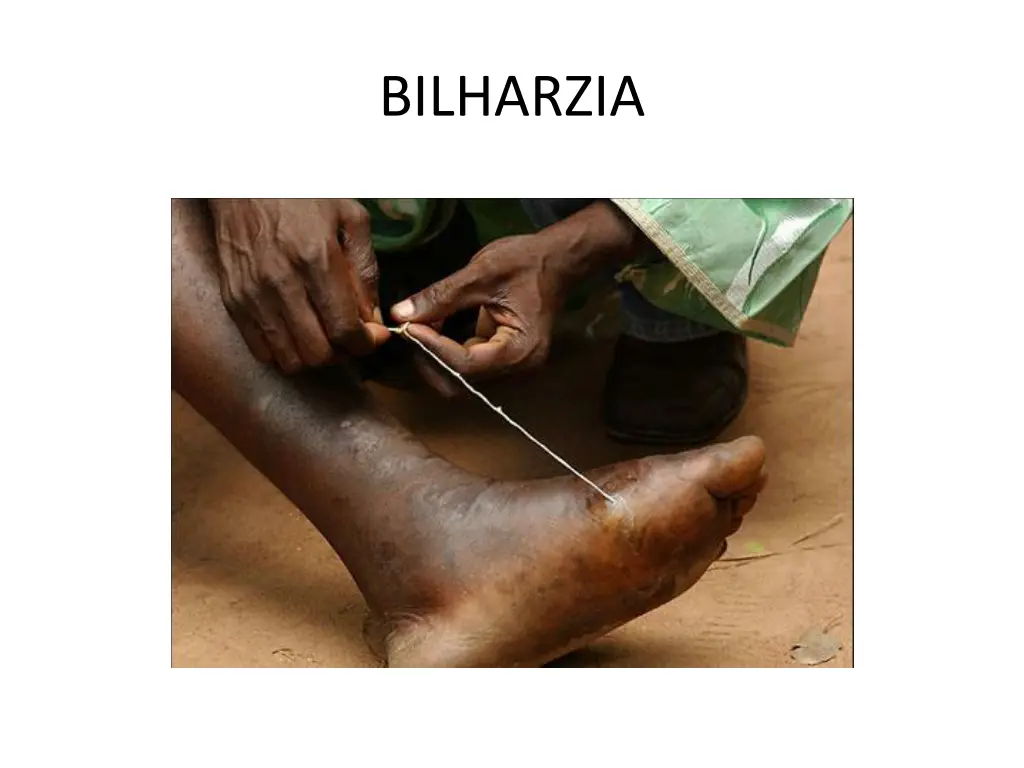 bilharzia 1