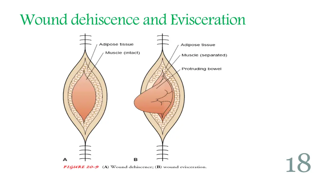 wound dehiscence and evisceration