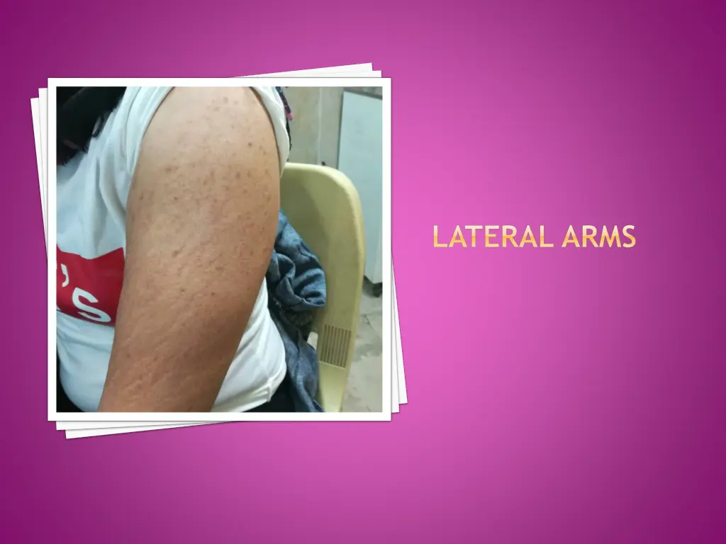 lateral arms