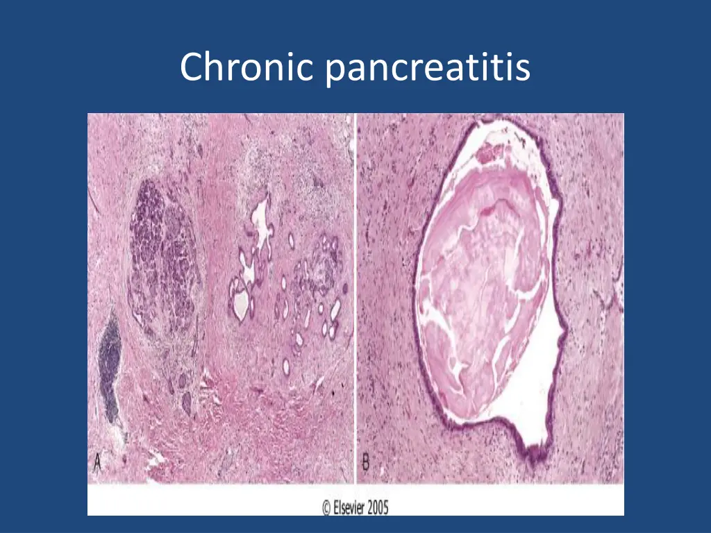 chronic pancreatitis 1