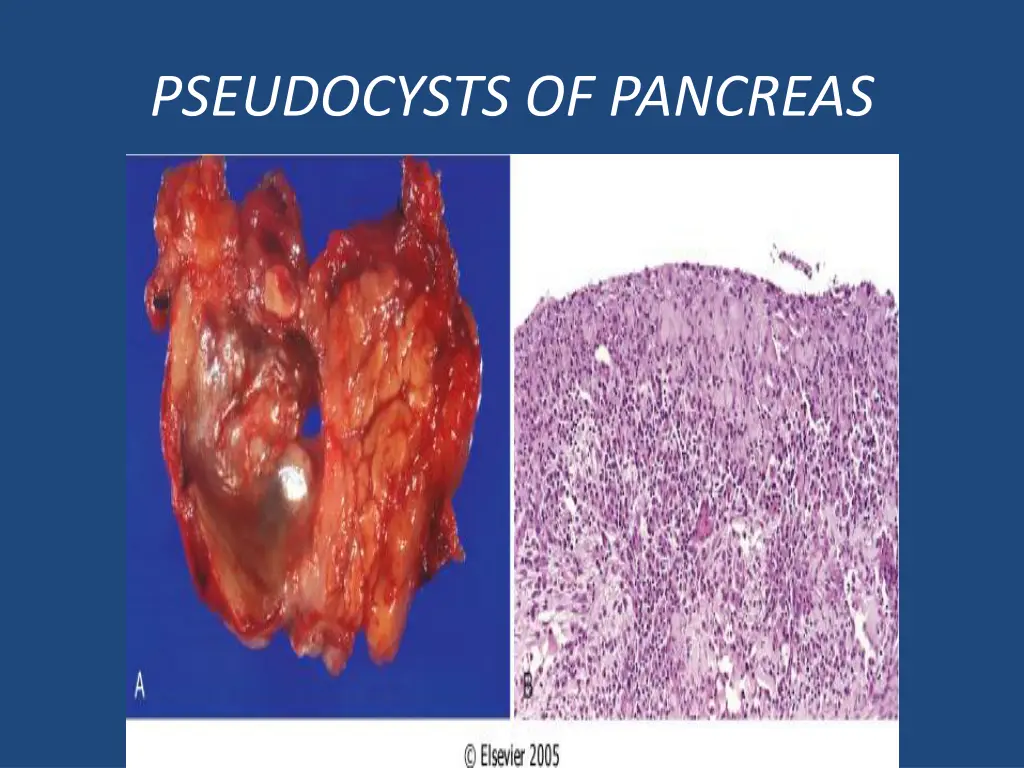 pseudocysts of pancreas 2