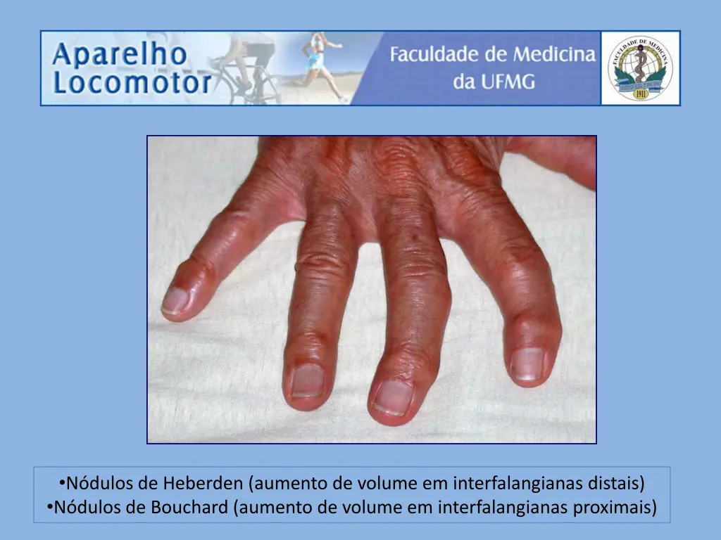 n dulos de heberden aumento de volume