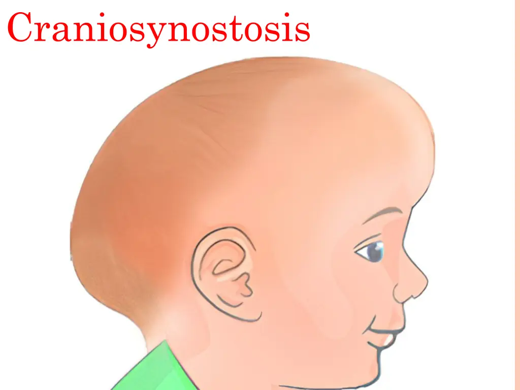 craniosynostosis