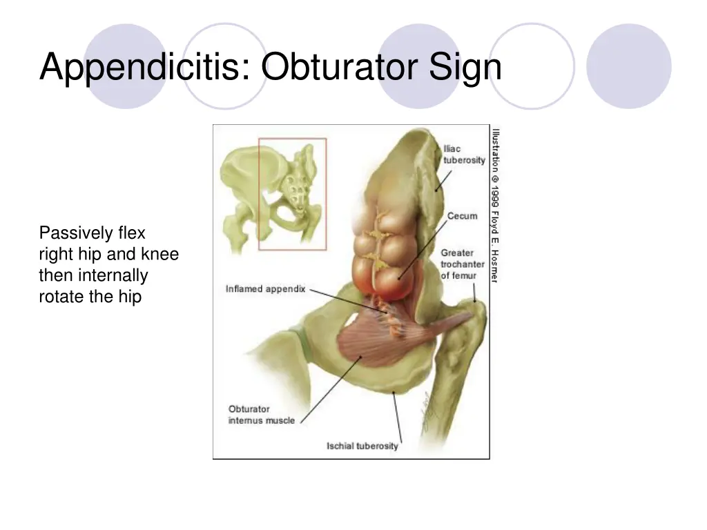 appendicitis obturator sign