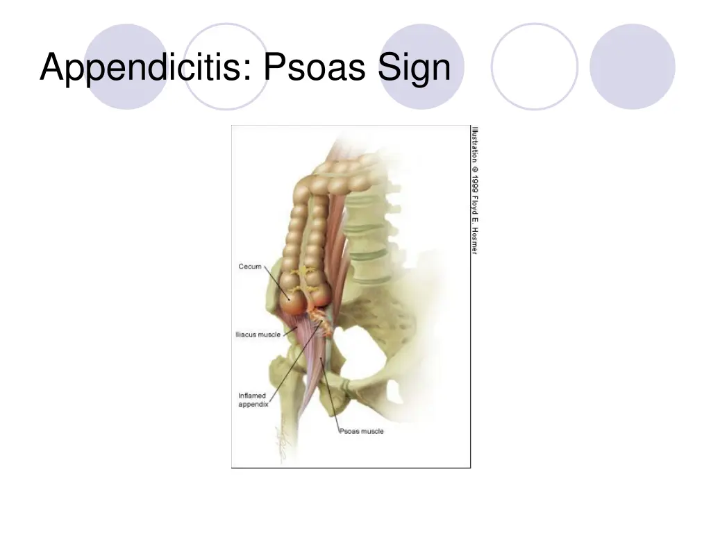 appendicitis psoas sign 1