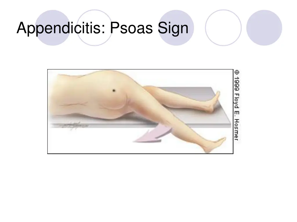 appendicitis psoas sign