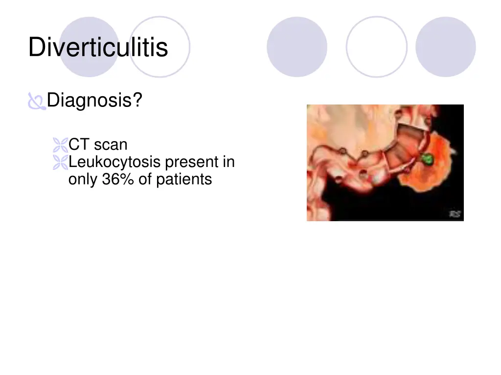 diverticulitis 2