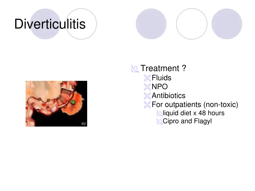 diverticulitis 3