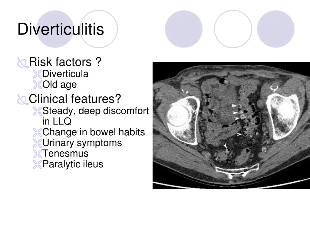 diverticulitis