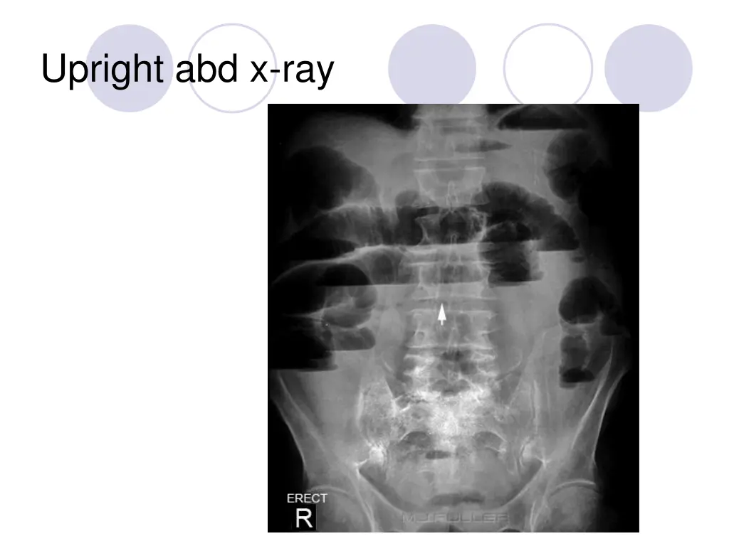 upright abd x ray