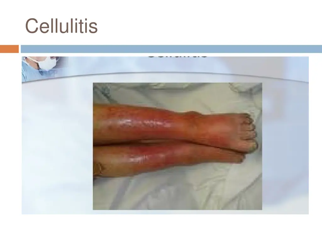 cellulitis 1