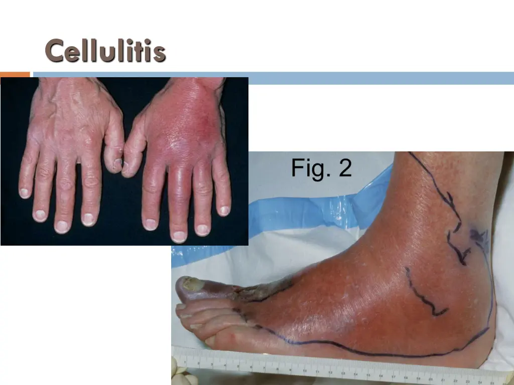 cellulitis 2