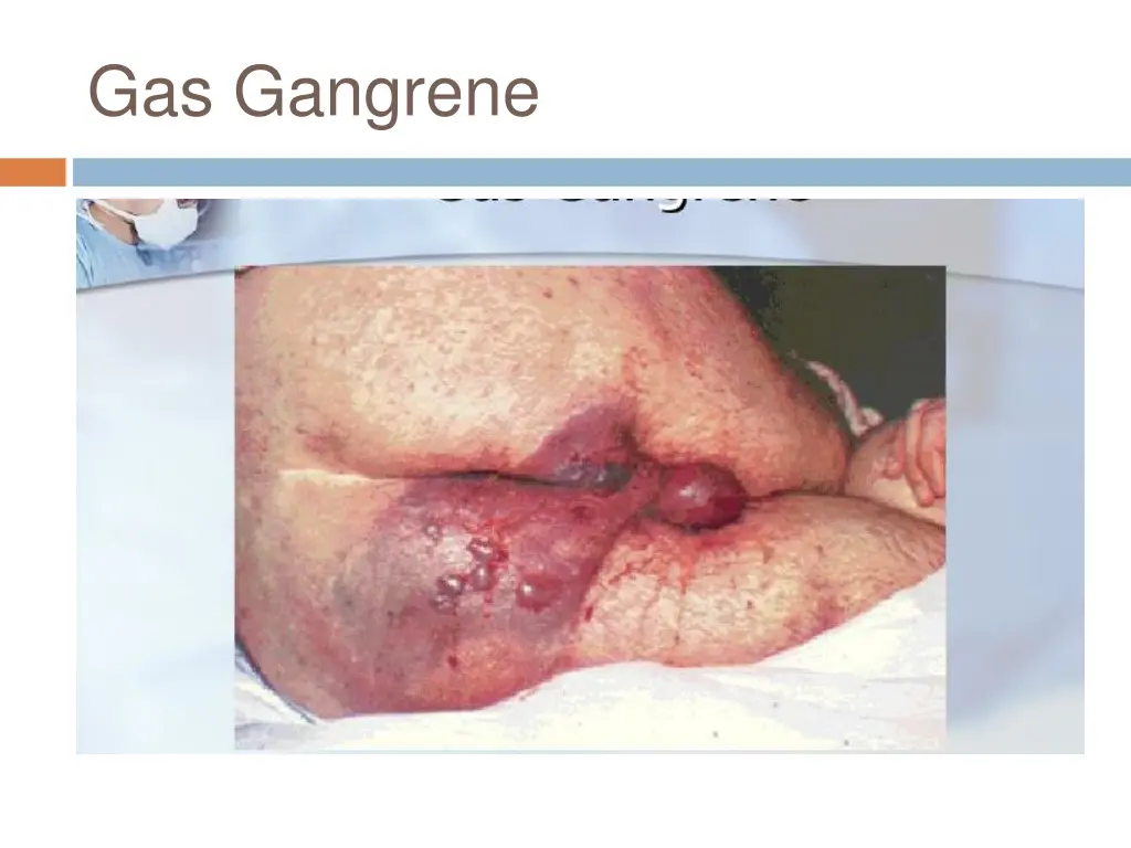 gas gangrene