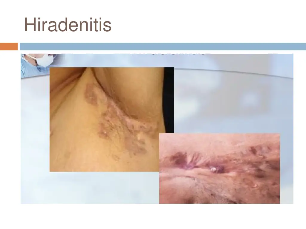 hiradenitis