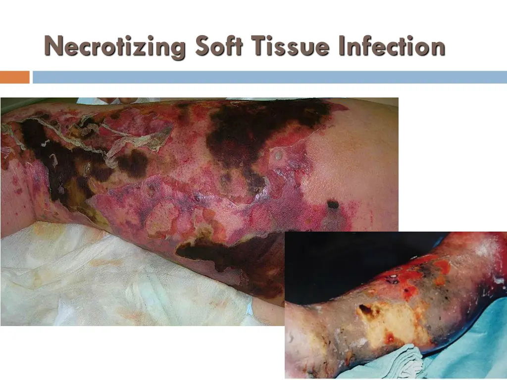 necrotizing soft tissue infection