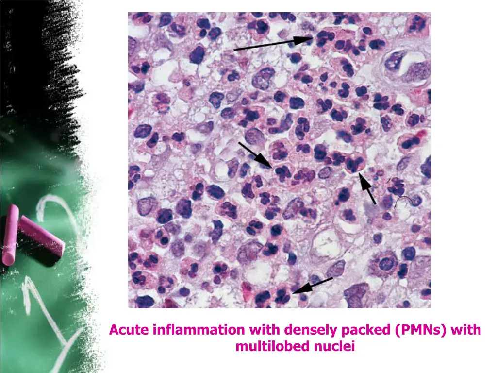 acute inflammation with densely packed pmns with