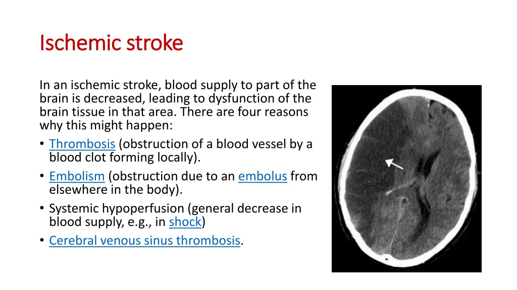ischemic stroke ischemic stroke