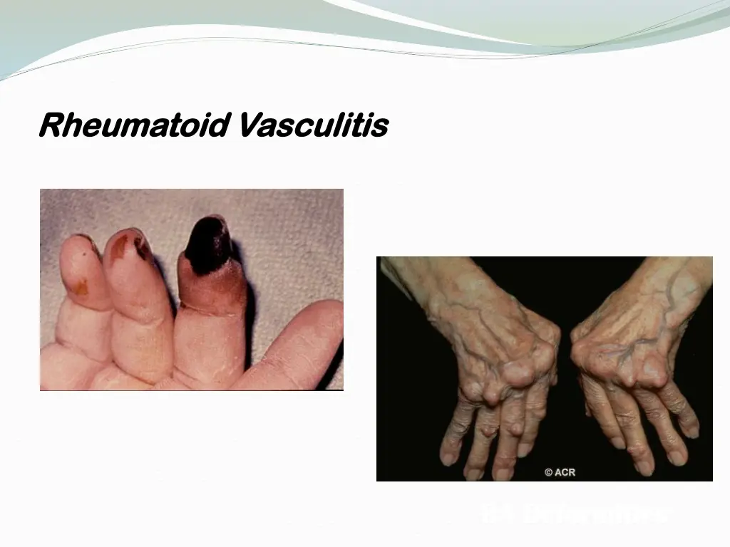 rheumatoid vasculitis rheumatoid vasculitis