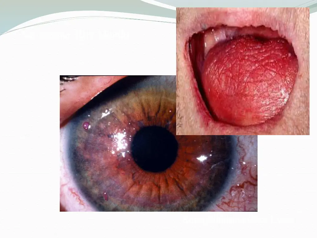xerostomia dry mouth