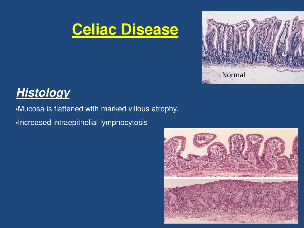 celiac disease