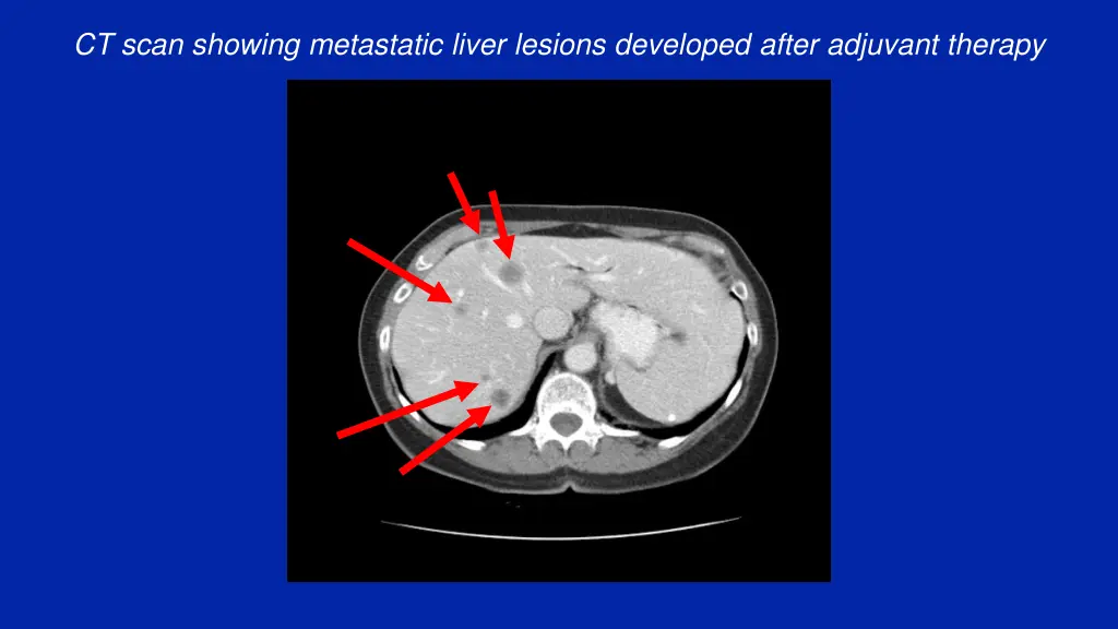 ct scan showing metastatic liver lesions