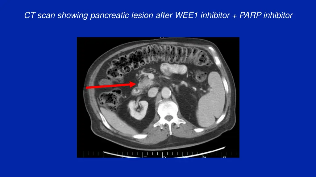 ct scan showing pancreatic lesion after wee1