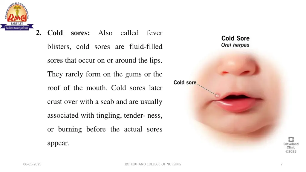 2 cold sores also called fever