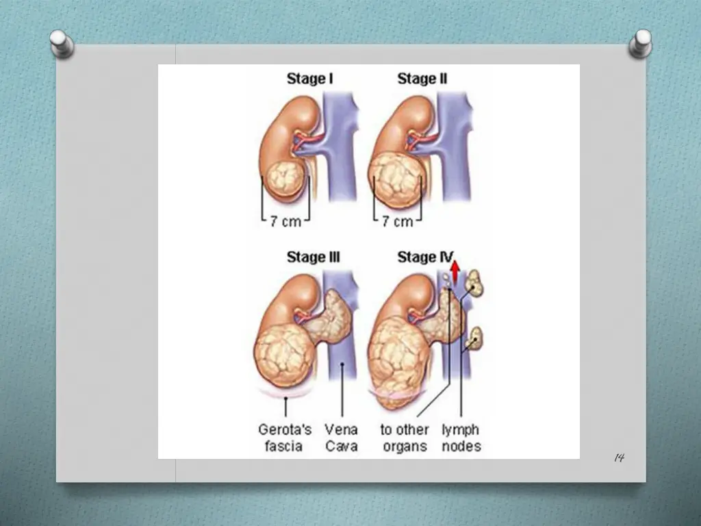slide14
