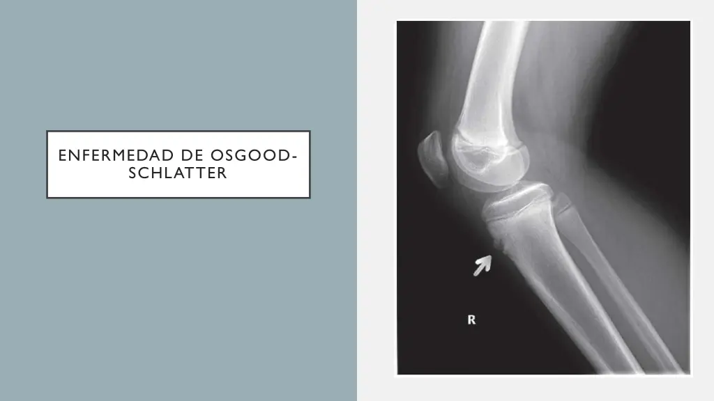 enfermedad de osgood schlatter