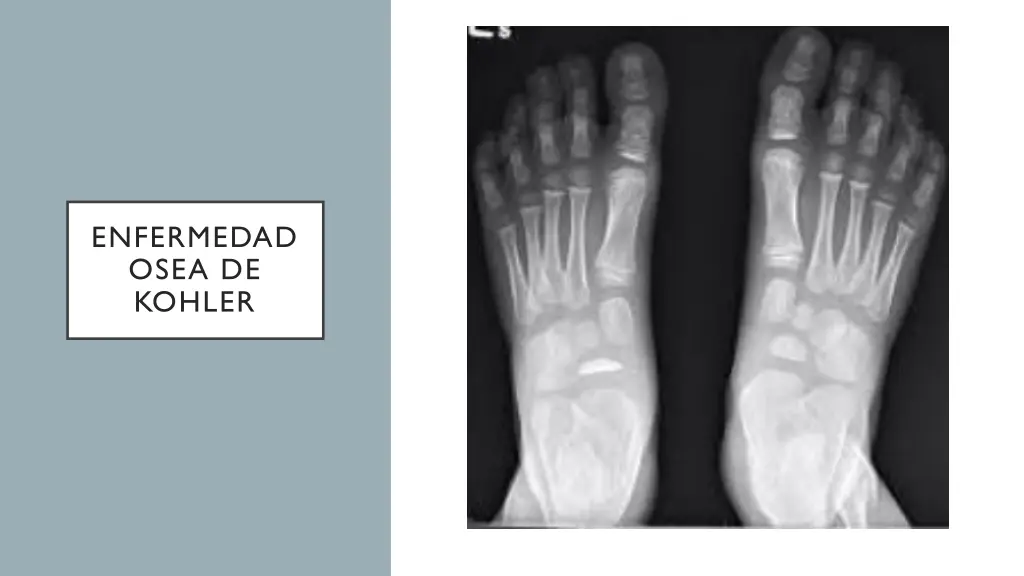 enfermedad osea de kohler