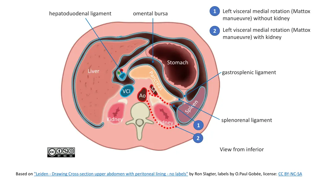 left visceral medial rotation mattox manueuvre