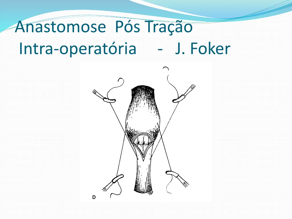 anastomose p s tra o intra operat ria