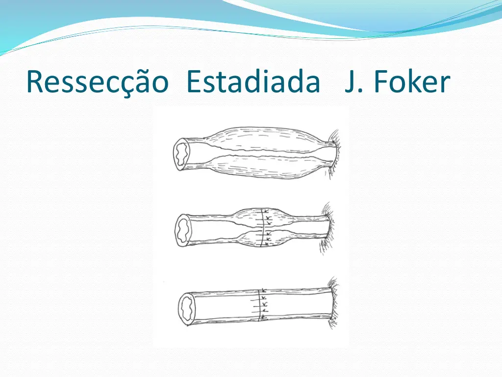 ressec o estadiada j foker