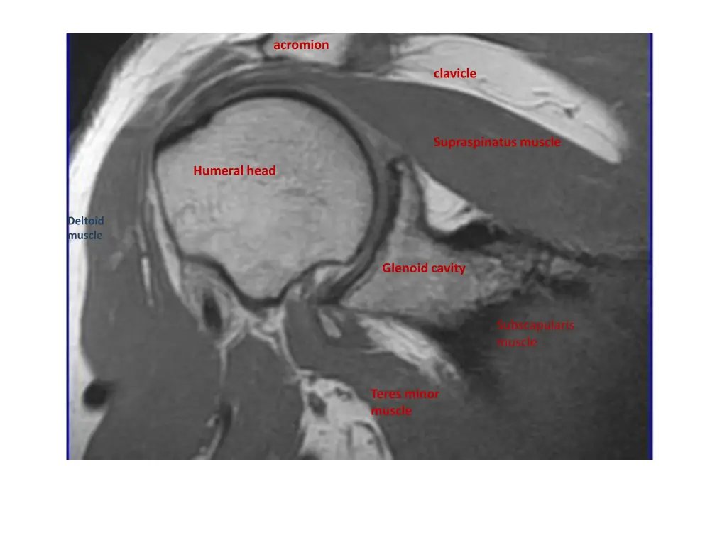 acromion 2