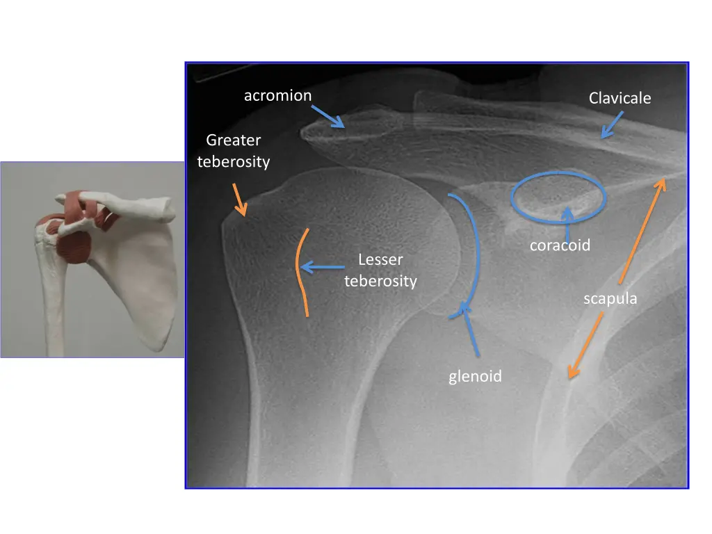 acromion