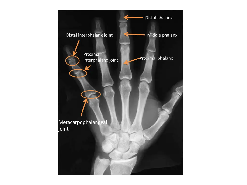 distal phalanx