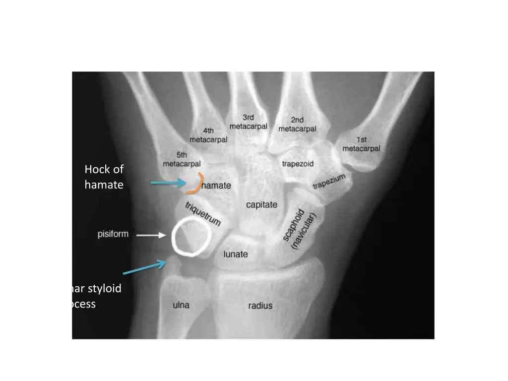 hock of hamate
