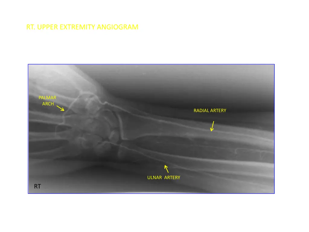 rt upper extremity angiogram 1