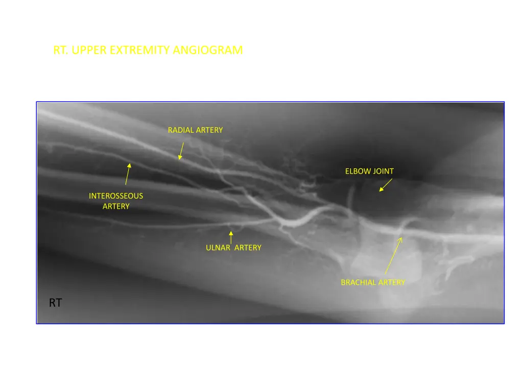 rt upper extremity angiogram
