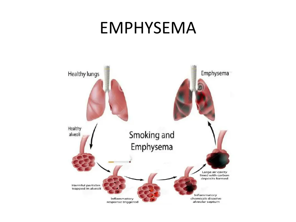 emphysema